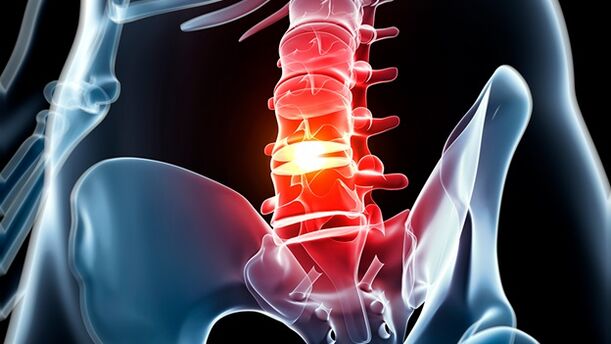 Lumbal -Säule Osteochondrose