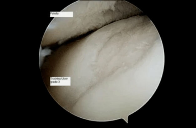 Astroskopische Ansicht eines Kniegelenks mit Arthrose dritten Grades.