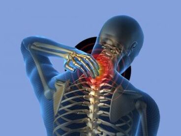 Eine Person mit Osteochondrose der Halswirbelsäule leidet unter Nackenschmerzen.