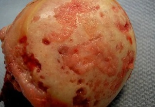 Betroffen Arthrose Knorpel Oberflächen